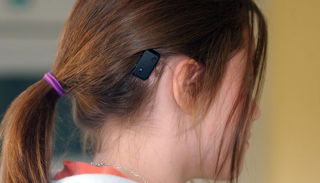 Bone Conduction Hearing Implants