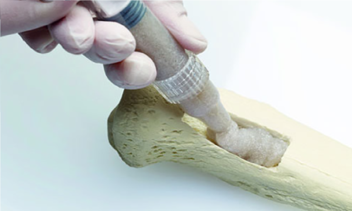 Bone Graft Substitutes