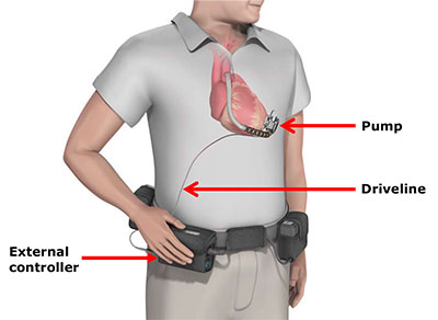 Cardiac Assist Devices