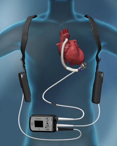 Cardiac Assist Devices