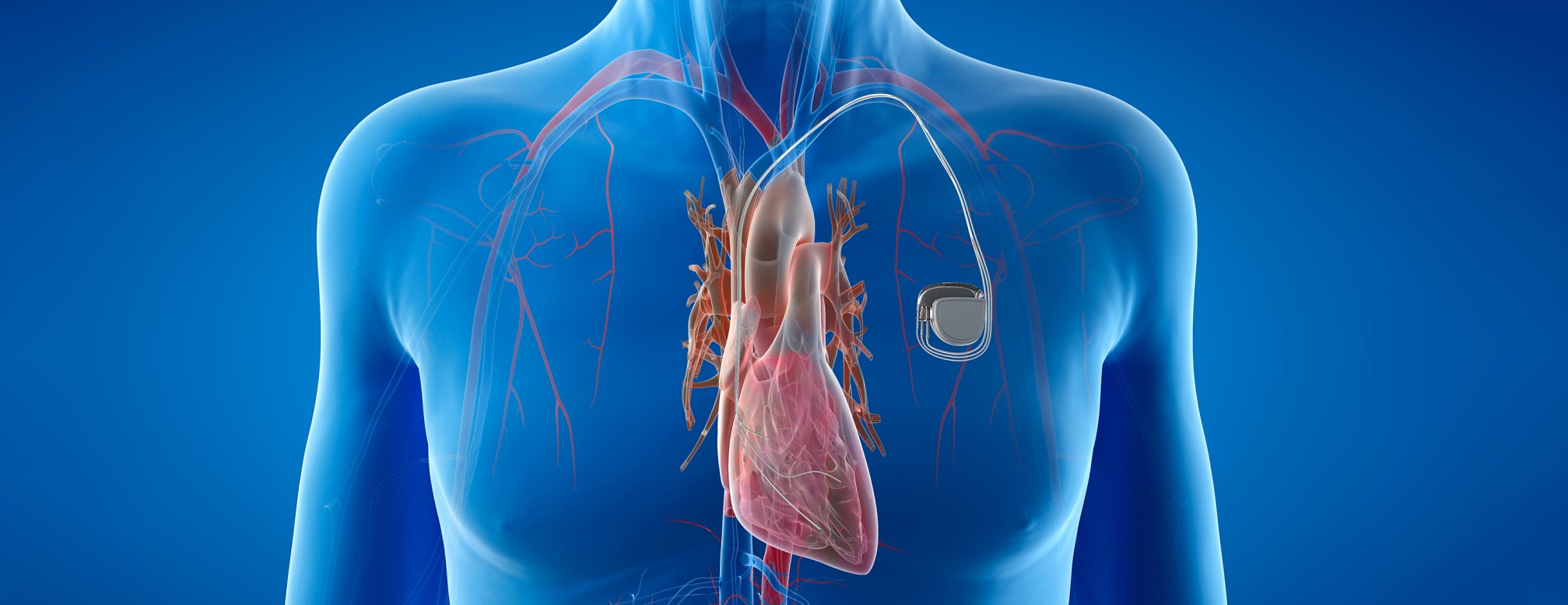 Cardiac Pacemakers