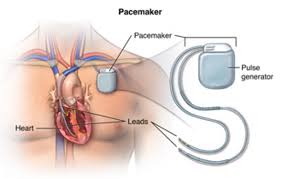 Cardiac Pacing