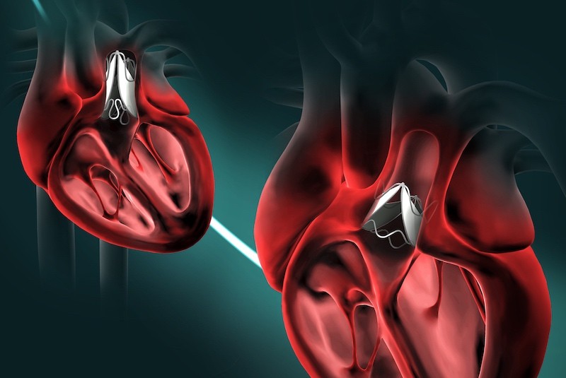 Cardiac Prosthetic Devices