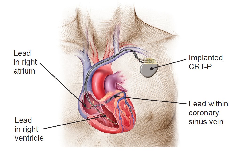 Cardiac Resynchronization Therapy Systems