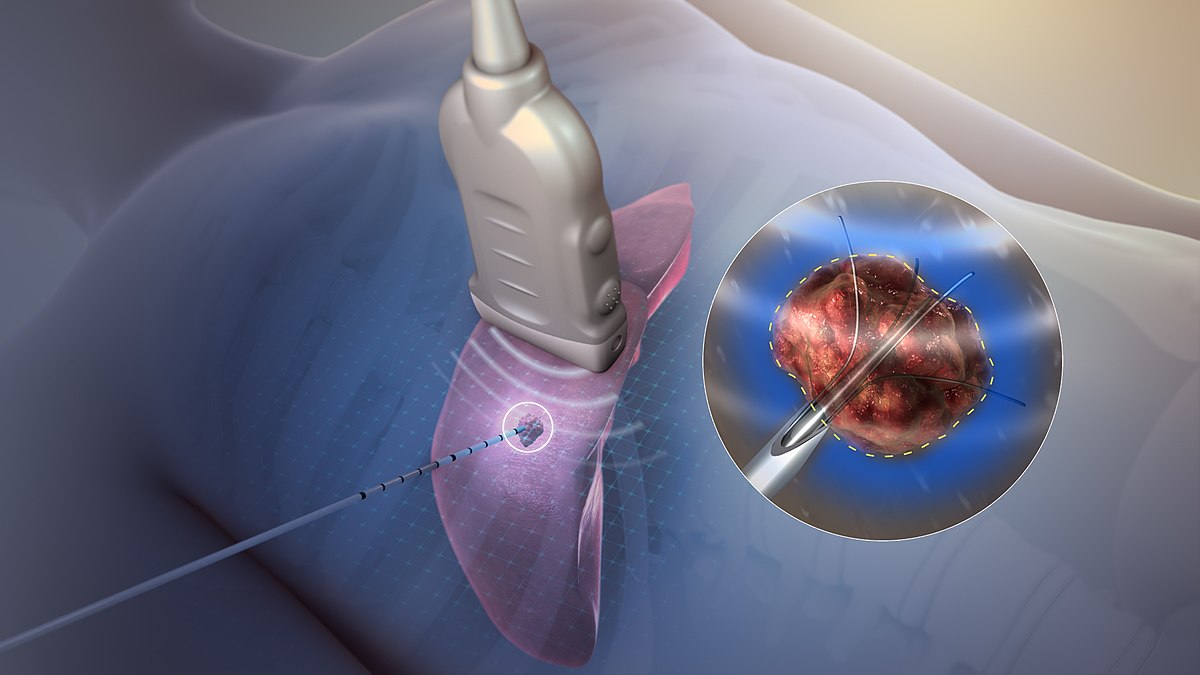 Cardiac or Radiofrequency (RF) Ablation Catheter Market