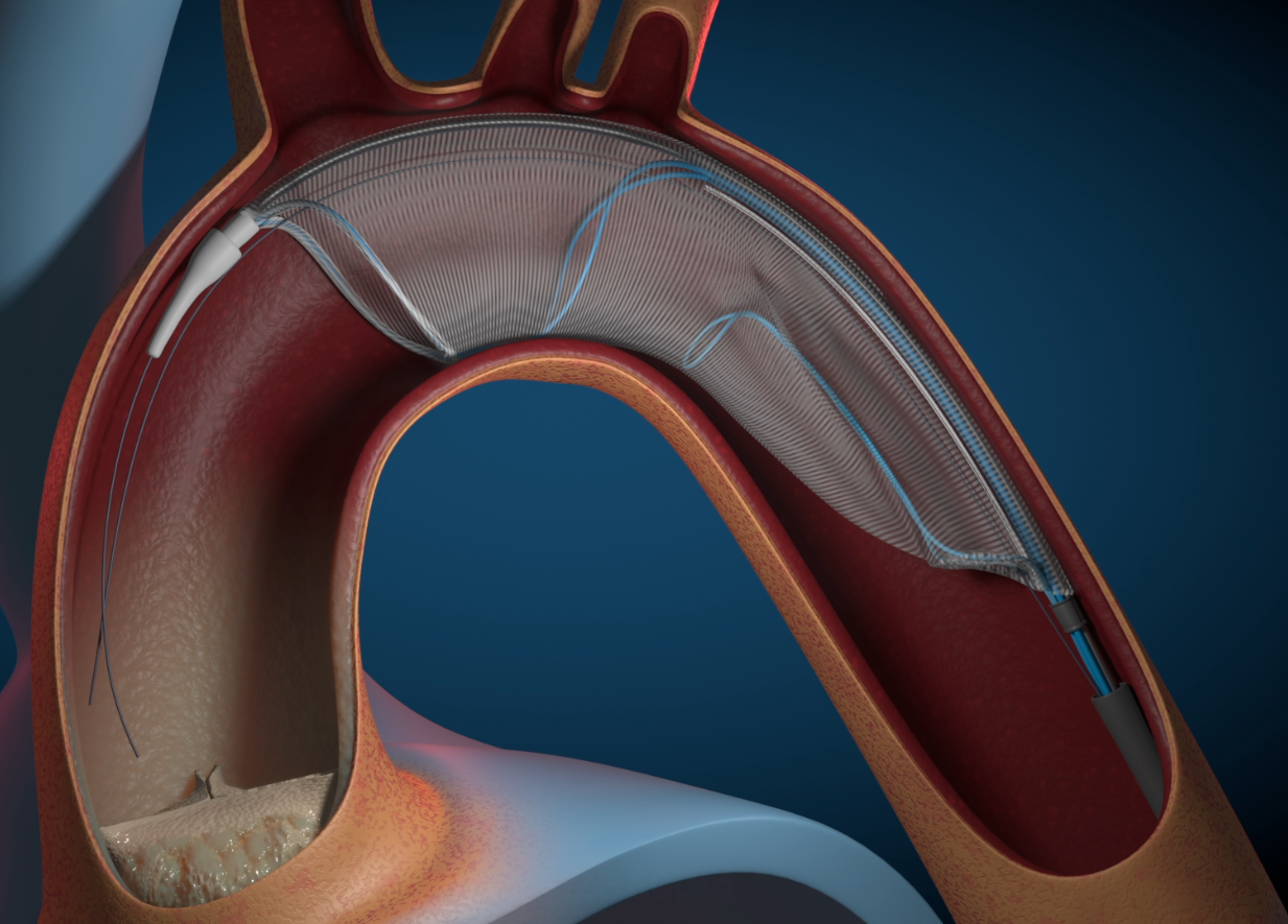 Cardiovascular Embolic Protection Device