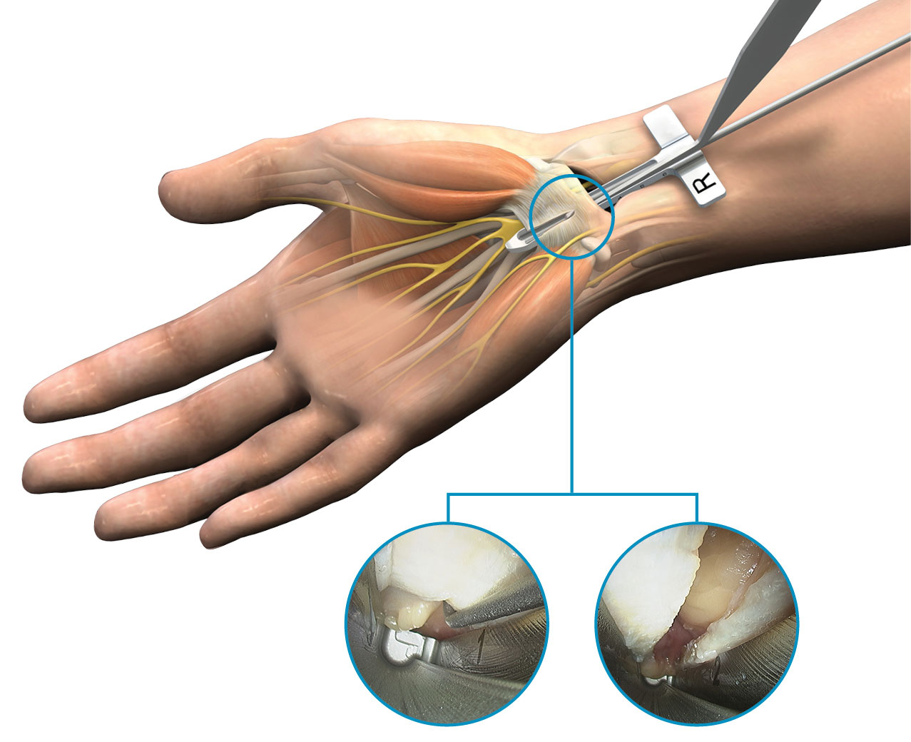 Carpal Tunnel Release Systems