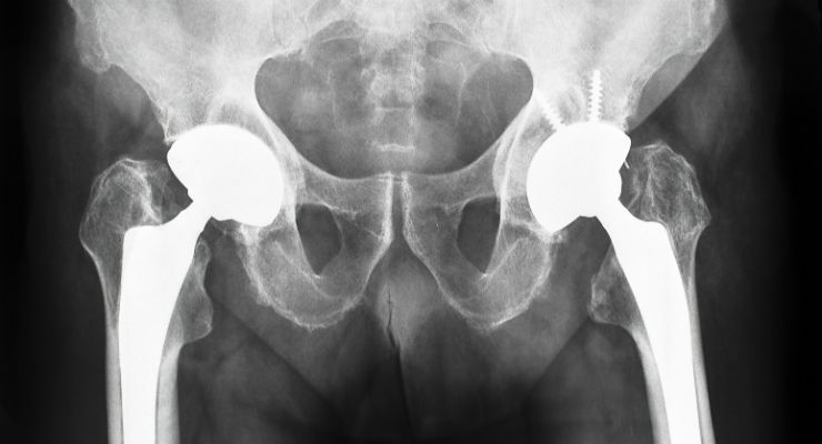 Cementless Acetabular Prosthesis