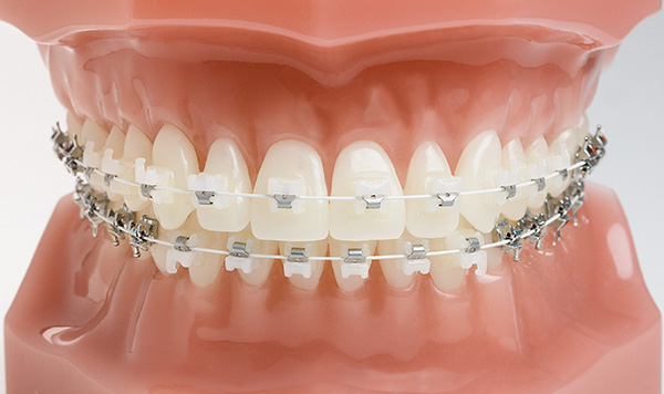Ceramic Invisible Bracket Market