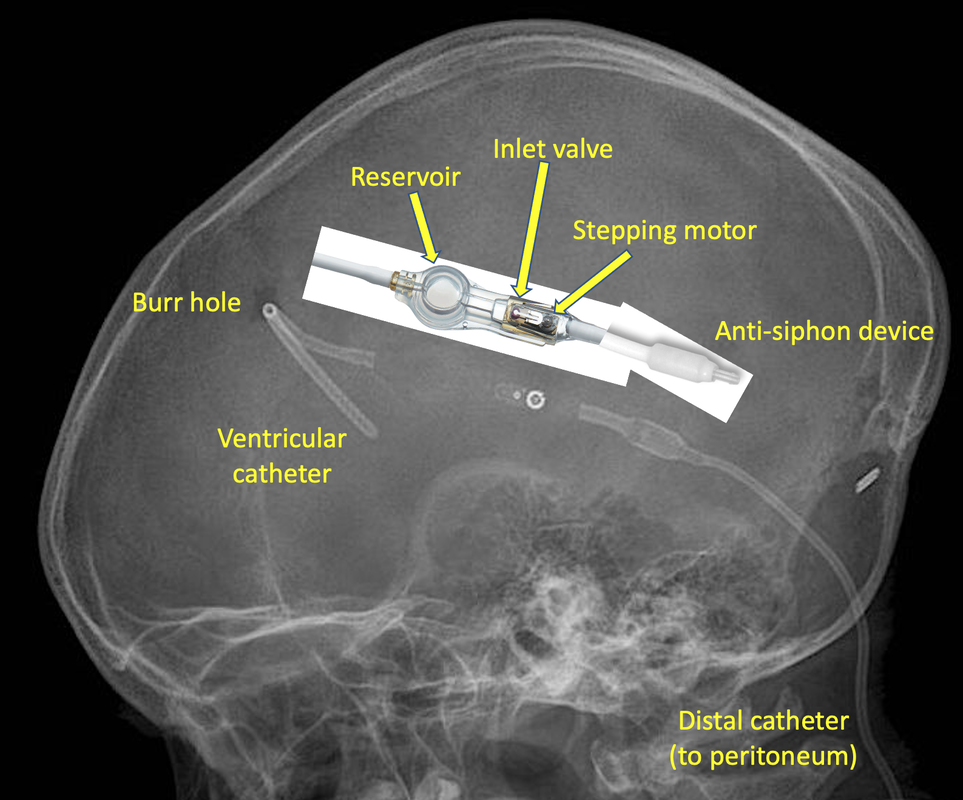 Cerebrospinal Fluid (CSF) Shunts