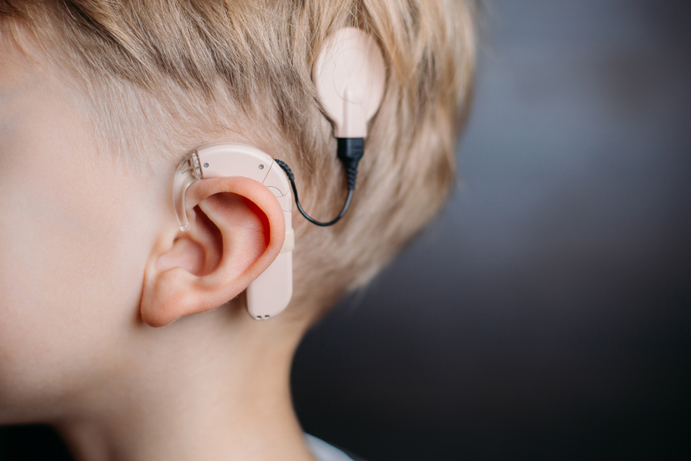 Cochlear Implants