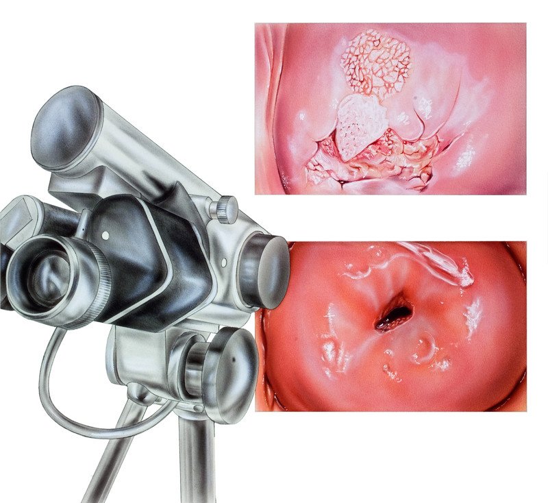 Colposcopy