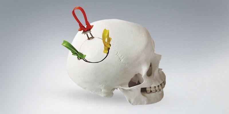 Cranial Fixation & Stabilization Systems market