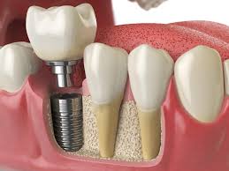 Dental Implant Prosthesis Market