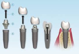 Dental Implant and Abutment