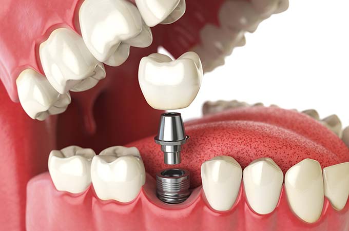 Dental Implants and Prosthetics