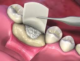 Dental Membrane