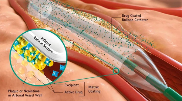 Drug-coated Balloon Dilatation Catheters