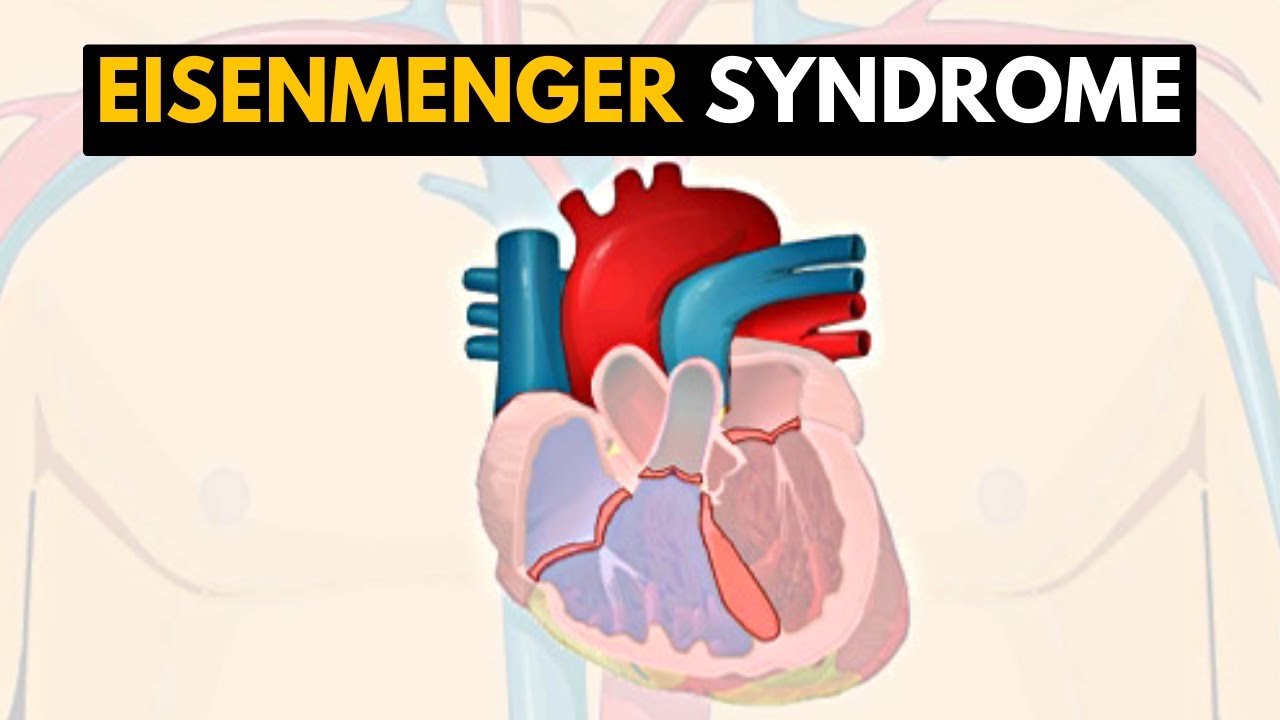 Eisenmenger Syndrome Treatment market