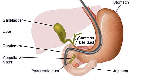 Endoscopic Retrograde Cholangiopancreatography (ERCP) Technique