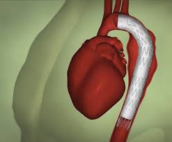 Endovascular Aortic Stent Grafts