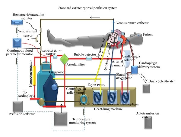 Extracorporeal Circulation Systems