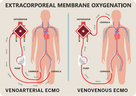 Extracorporeal Membrane Oxygenation (ECMO) Service