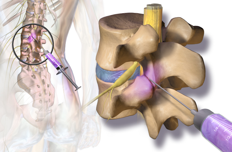 Facet Joint Injections market