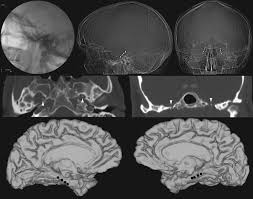 Foramen Ovale Electrodes