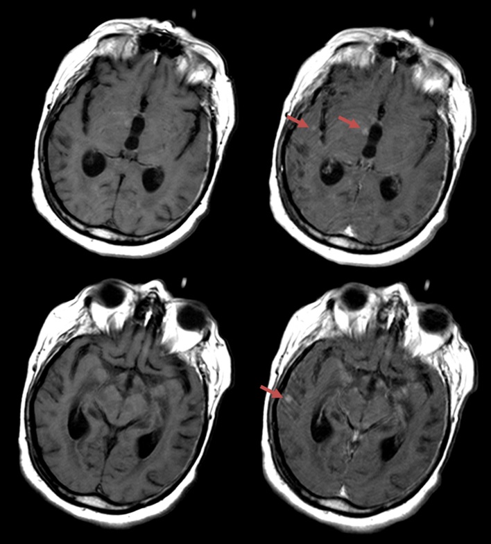 Gadolinium Contrast Medium