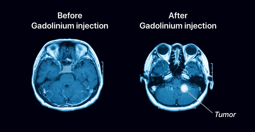 Gadolinium-based Contrast Media