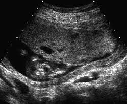 Gestational Trophoblastic Disease Market