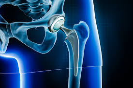 Hip Endoprosthesis Market