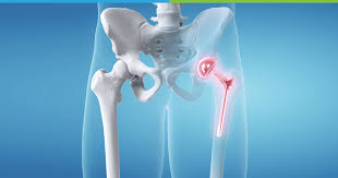 Hip and Knee Replacement Market