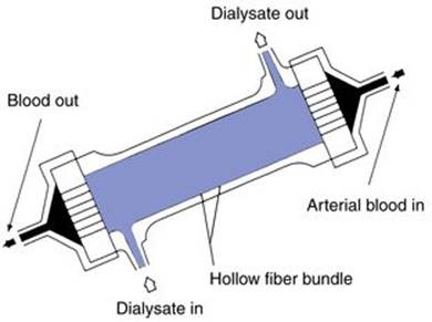 Hollow Fiber Dialyzer