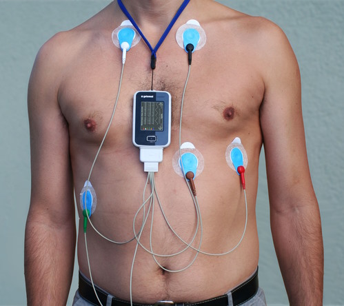 Holter ECG Monitoring