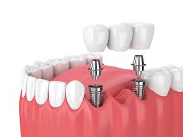 Implant Abutment