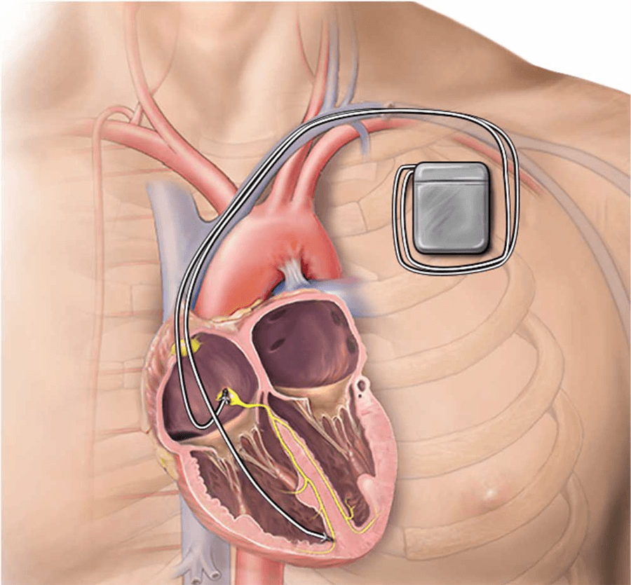 Implantable Defibrillators