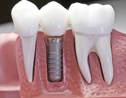 Implanted Teeth