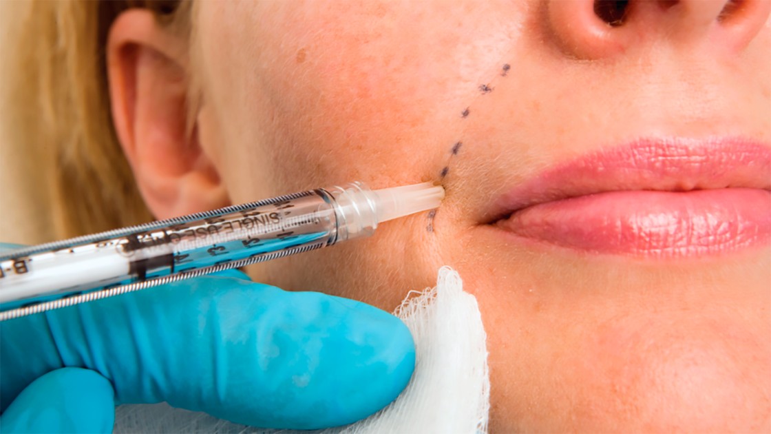 Injectable Dermal Filler