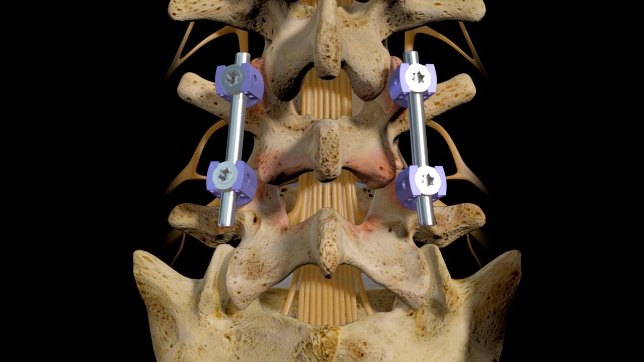 Interbody Fusion Cage Market