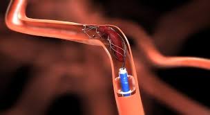 Intracranial Stents Market