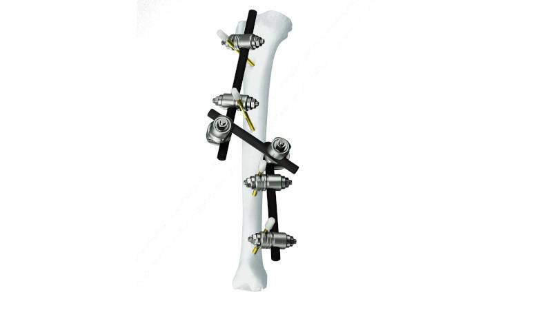 Knee External Fixation System market