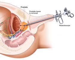 Laser Benign Prostatic Hyperplasia (BPH) Devices market