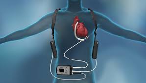 Left Ventricular Assist Device