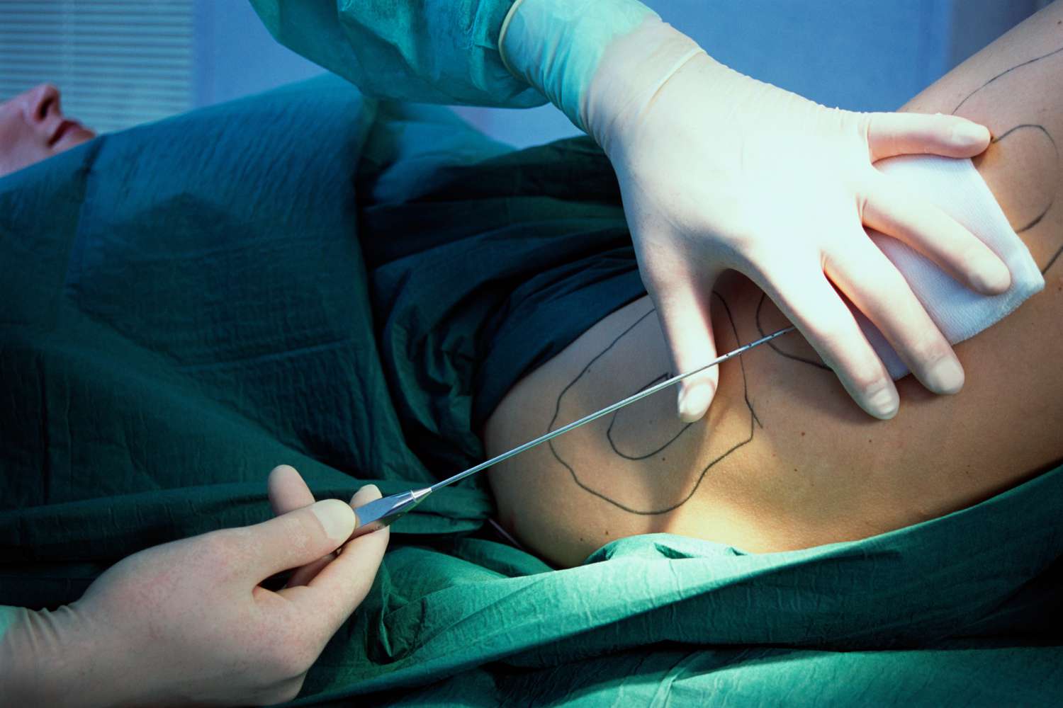 Liposuction Surgery Devices market