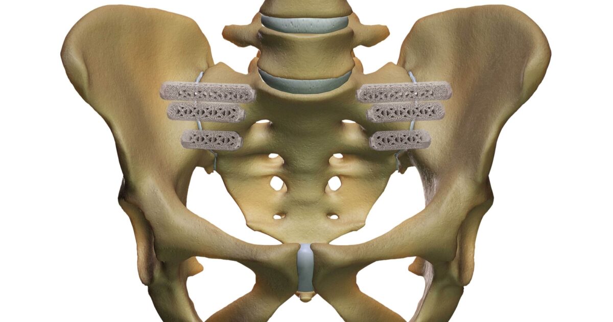 MIS Sacroiliac Joint Fusion