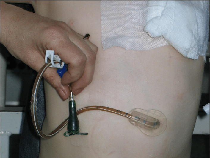 Medical Gastrostomy Feeding Tube