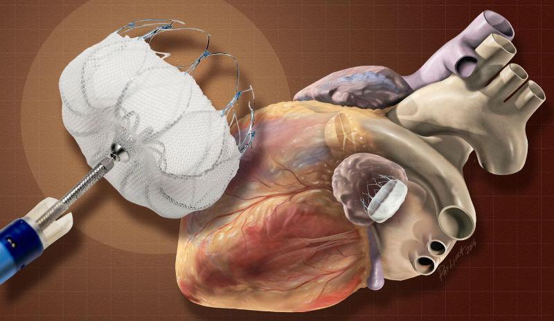 Neurovascular Devices & Interventional Neurology