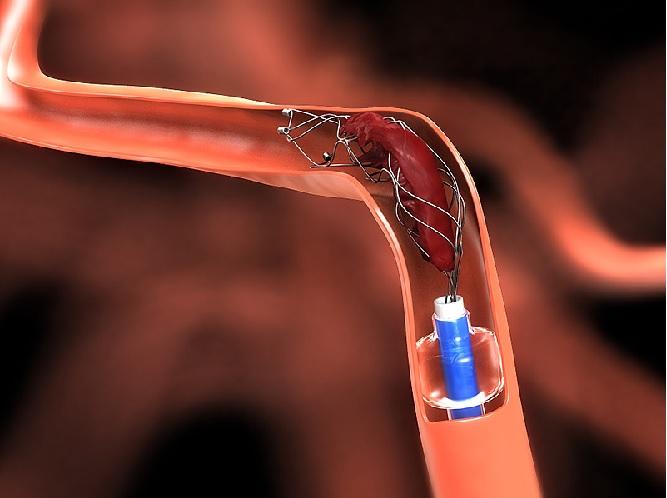 Neurovascular Stent Retrievers